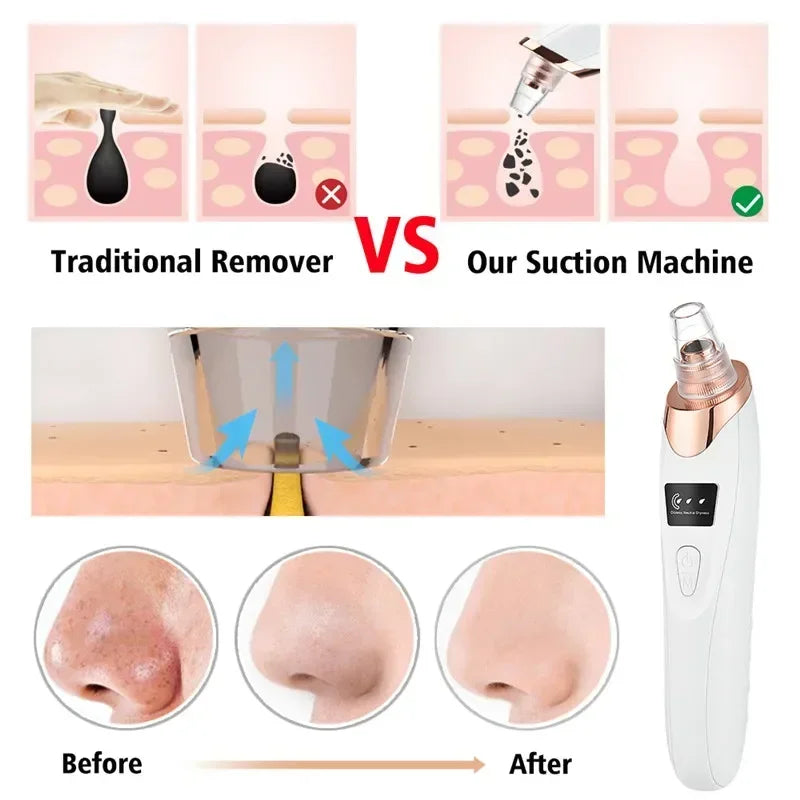 USB Rechargeable Blackhead Remover Vacuum – Deep Pore Cleaner with 5 Suction Heads for Acne & Comedone Extraction - SmartPlaceShop