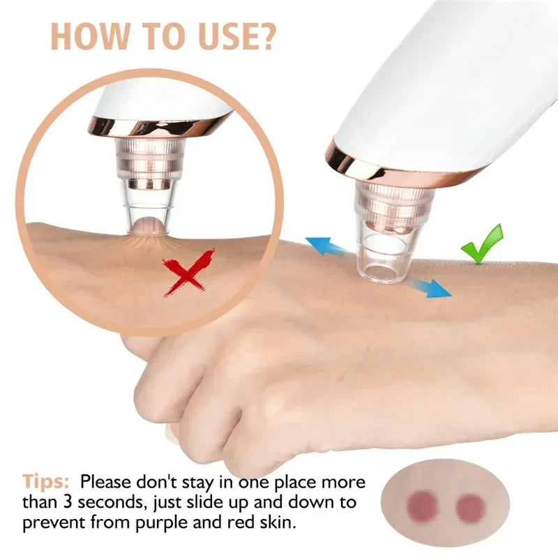 USB Rechargeable Blackhead Remover Vacuum – Deep Pore Cleaner with 5 Suction Heads for Acne & Comedone Extraction - SmartPlaceShop